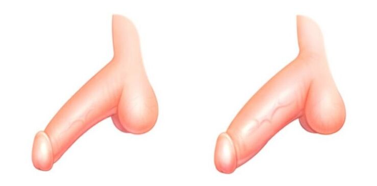 Członek przed i po zwiększeniu